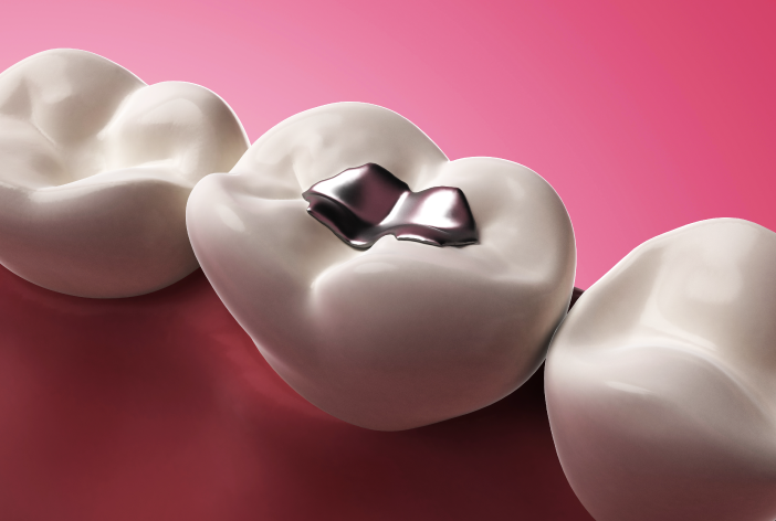 DENTISTA-LOCARNO-PONCHIO-AMALGAME-servizi-per-adulti - amalgama - dentale