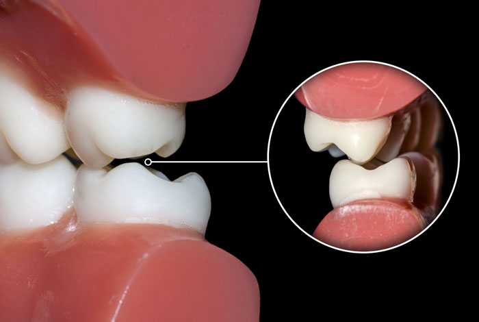 Dentista-Locarno-Studio-Ponchio-Malo-occlusioni