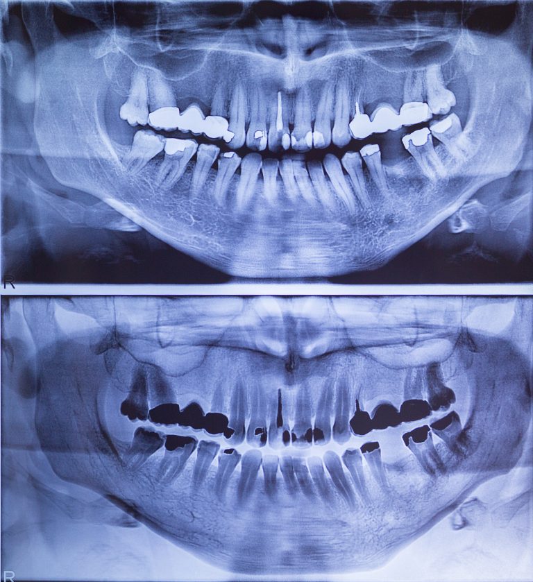 radiogtafia_dentale_studio_ponchio_locarno
