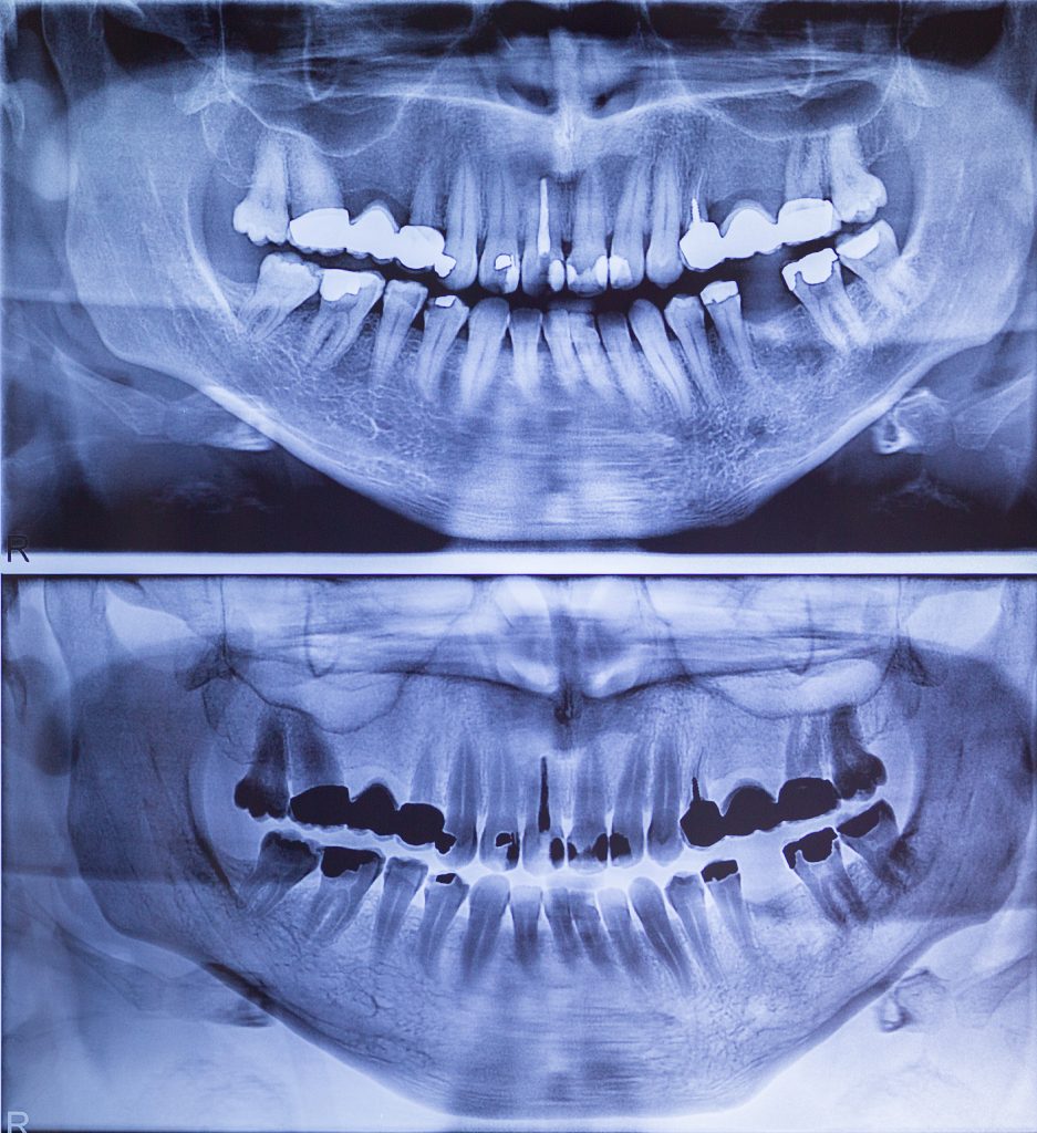 radiogtafia_dentale_studio_ponchio_locarno